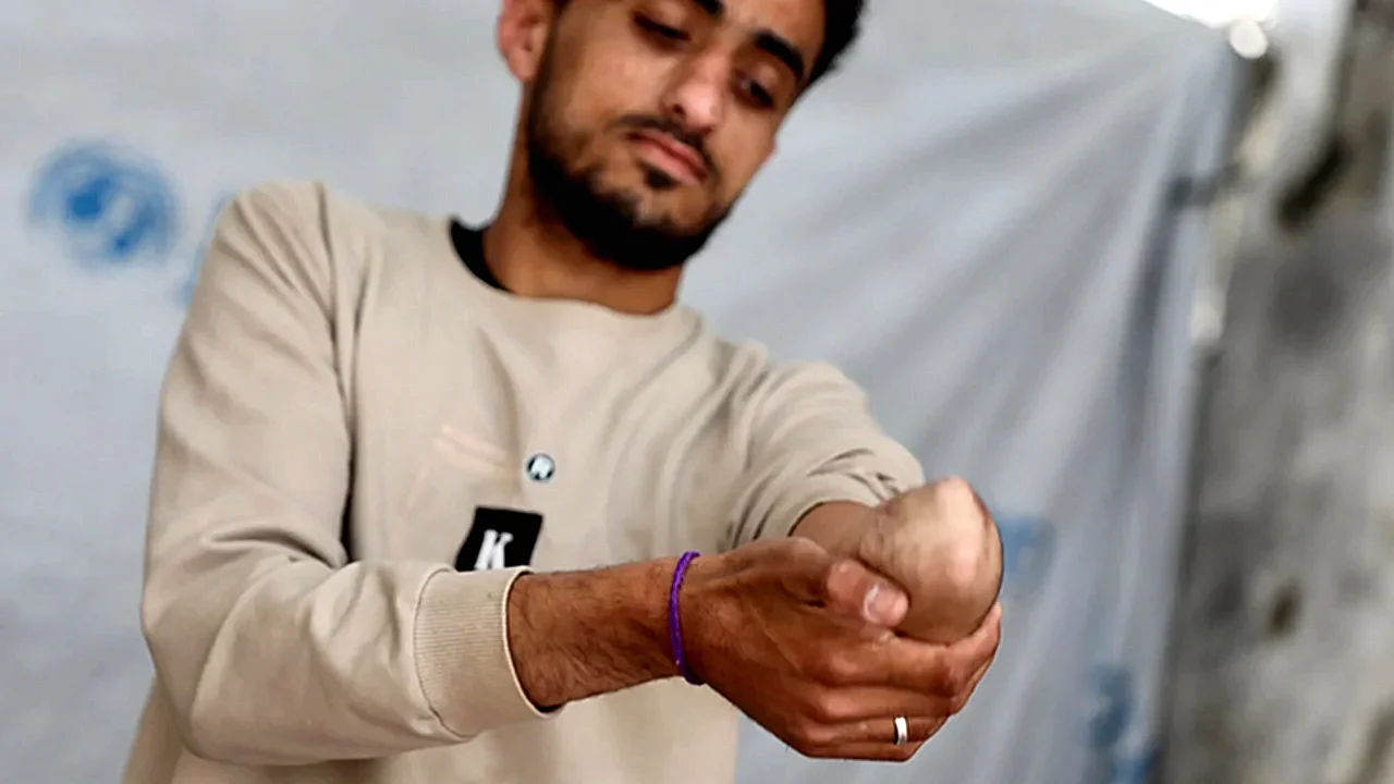 مصابو غزة يعانون مصاب فلسطيني في غزة يستخدم طرفًا صناعيًا
